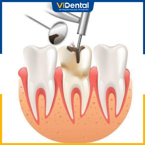 Sau khi trám răng lấy tủy bệnh nhân sẽ cảm thấy đau nhức nhẹ 