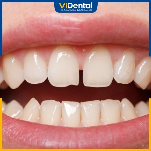 Răng thưa là tình trạng răng miệng thường gặp