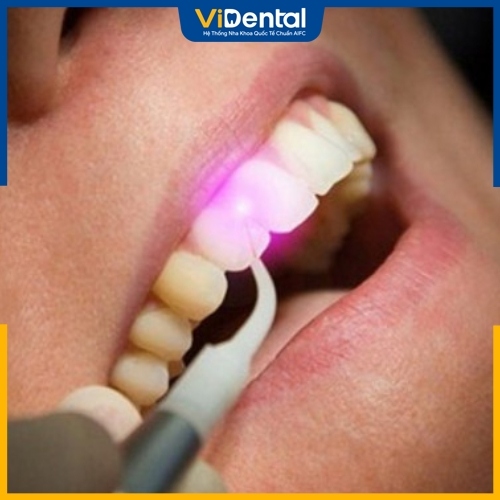 Hàn răng bằng công nghệ Laser Tech tại Nha khoa ViDental
