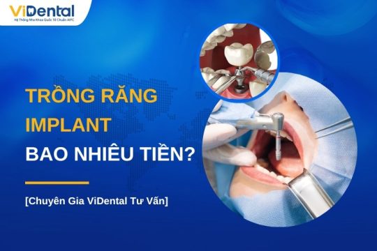 Trồng răng Implant giá bao nhiêu