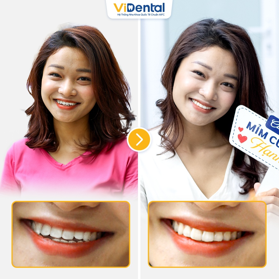Hình ảnh của Hà My trước và sau khi niềng răng tại ViDental