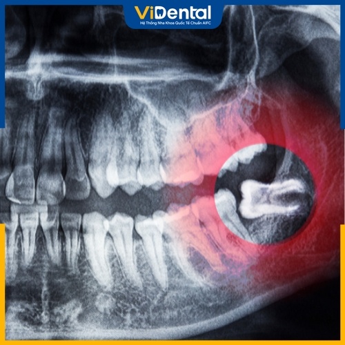 Chụp X-quang răng khôn có vai trò vô cùng quan trọng