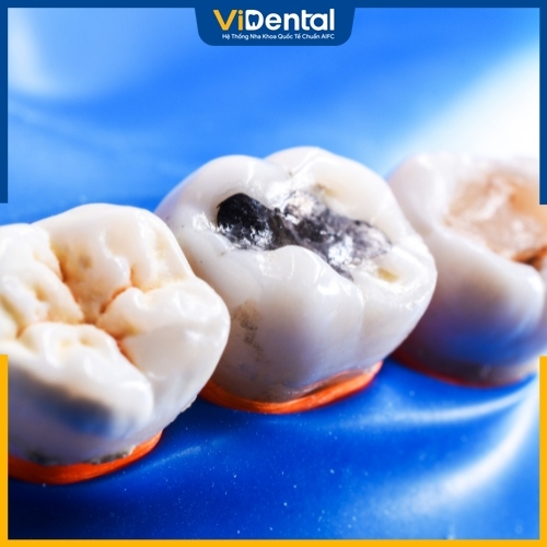 Trám răng giúp khắc phục sâu răng hiệu quả