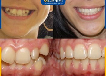 Niềng răng khớp cắn sâu