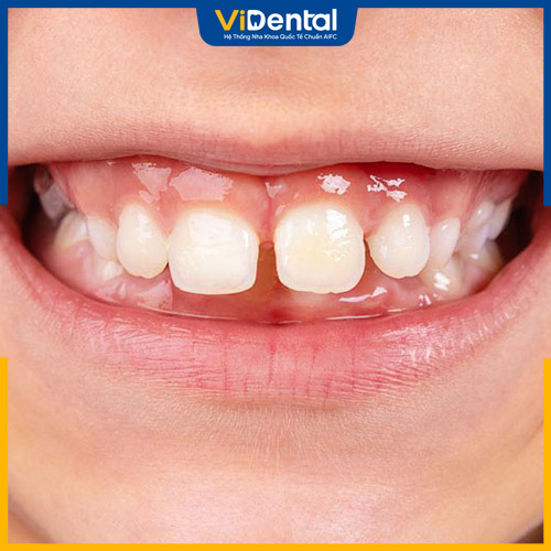 Tình trạng 4 răng cửa bị hô có thể gặp ở cả trẻ nhỏ và người lớn