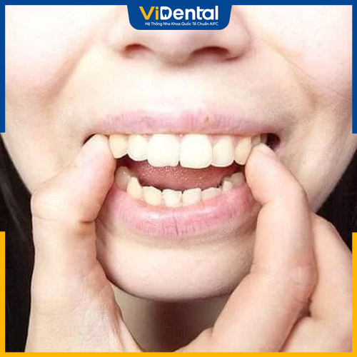 Răng hô ảnh hưởng đến tính thẩm mỹ của gương mặt