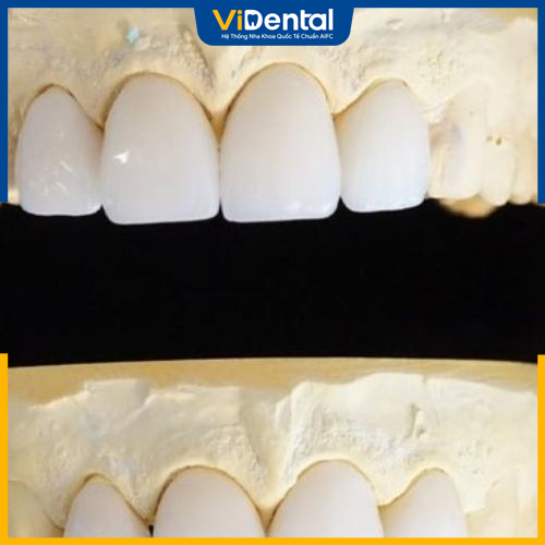 Bị hô 4 răng cửa có thể bọc răng sứ để cải thiện