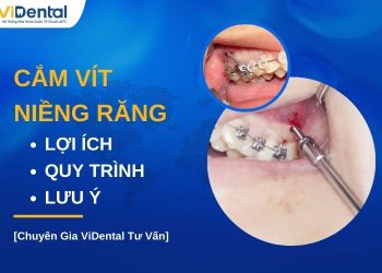 Cắm vít niềng răng có tác dụng gì
