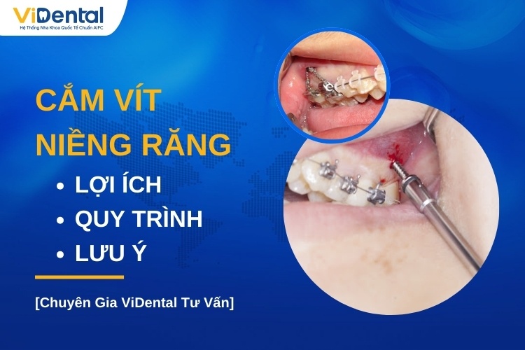 Cắm minivis niềng răng là gì? - Nha khoa Việt Nha