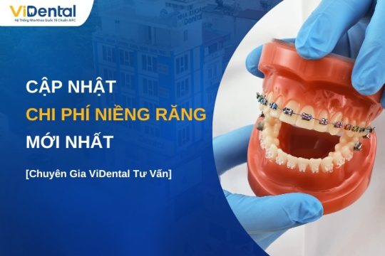 Cập nhật bảng giá niềng răng mới nhất hiện nay