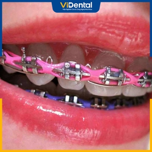 Trong quá trình dùng chun chuỗi niềng răng có thể xuất hiện một số vấn đề