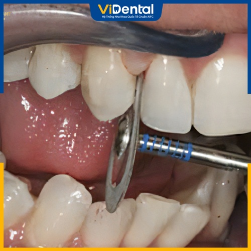 Mài kẽ răng là thủ thuật nha khoa quan trọng trong phương pháp niềng răng