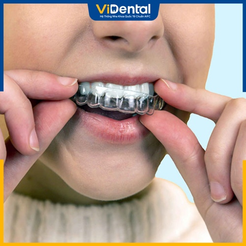 Người mất răng có thể dùng khay niềng Invisalign 