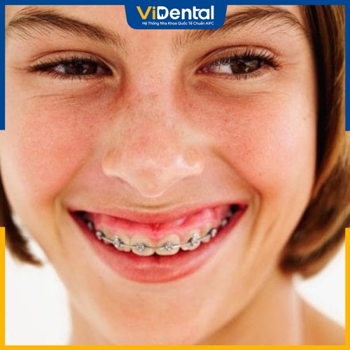 Niềng răng chỉ áp dụng hiệu quả cho bệnh nhân cười hở lợi nhẹ 