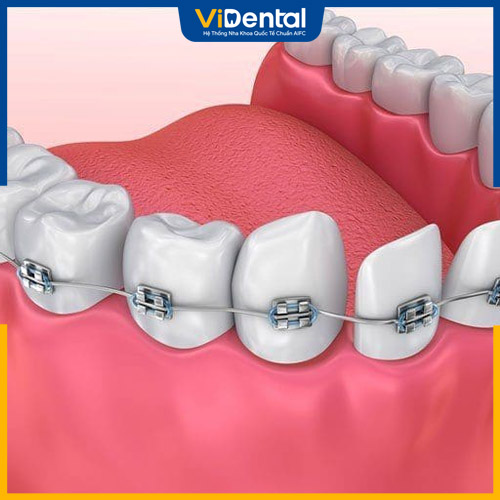 Niềng răng hàm dưới có thể thực hiện với một số trường hợp nhất định