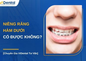 Niềng răng hàm dưới có được không