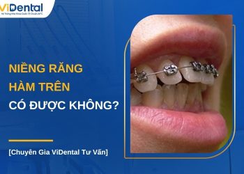 Niềng răng hàm trên có được không