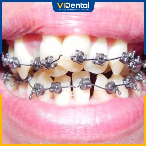 Răng chạy về vị trí cũ là biến chứng nguy hiểm của ca niềng răng hỏng 