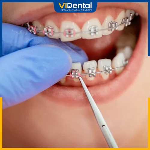 Sau khi răng đã ổn định, nha sĩ sẽ tháo mắc cài và đeo hàm duy trì cho bệnh nhân 