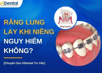 Răng lung lay khi niềng có nguy hiểm không