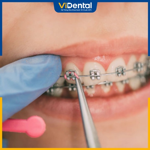Siết răng khi niềng là một công đoạn quan trọng trong chỉnh nha