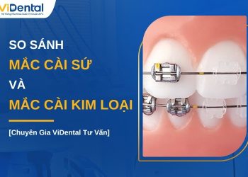 So sánh mắc cài sứ và kim loại nên niềng loại nào