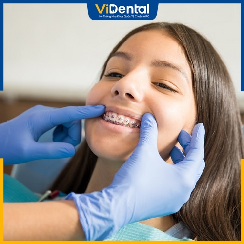 Khi răng đã dịch chuyển về đúng vị trí, nha sĩ sẽ tháo khí cụ