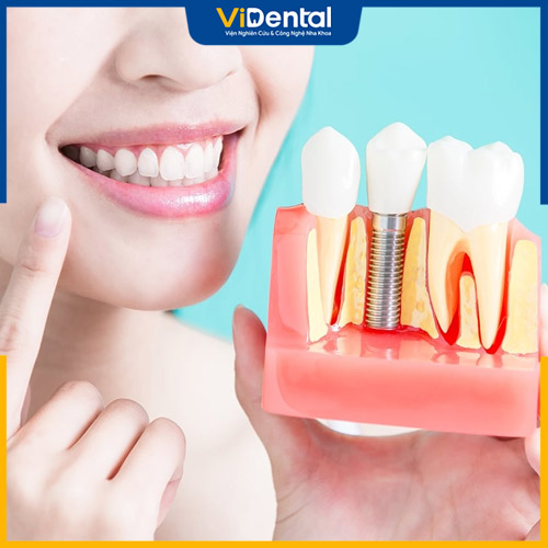Trồng răng là phương pháp cấy trụ implant cố định vào xương hàm