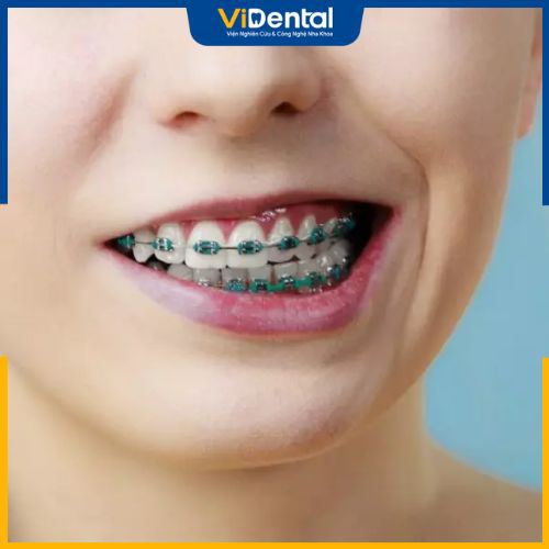 Niềng răng là phương pháp kéo chỉnh các răng đến vị trí mong muốn
