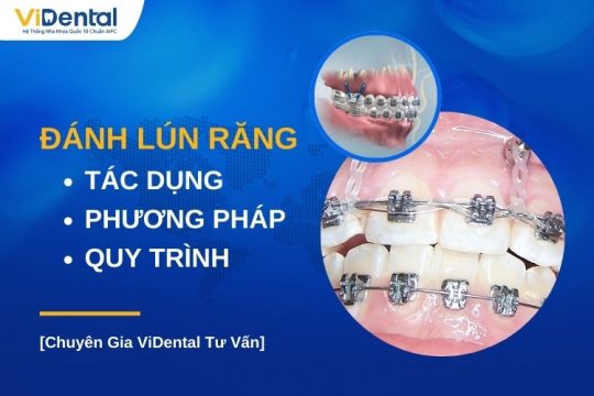 Đánh lún răng có tác dụng gì