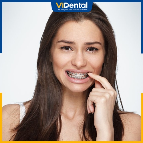 Giai đoạn xấu nhất khi niềng răng là giai đoạn dàn đều răng trên cung hàm