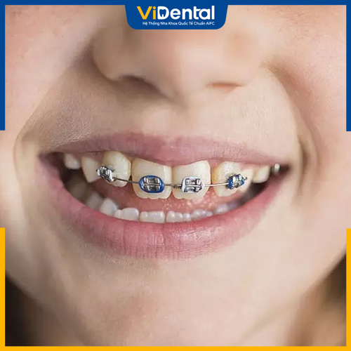 Kéo cụm 4 răng cửa hàm trên thực hiện trong 4 - 8 tháng