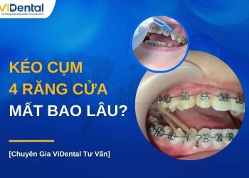 Kéo cụm 4 răng cửa mất bao lâu