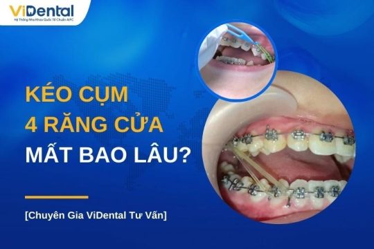 Kéo cụm 4 răng cửa mất bao lâu