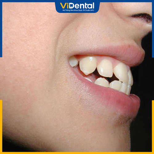 Tình trạng răng hô, móm đều có thể sử dụng loại mắc cài này