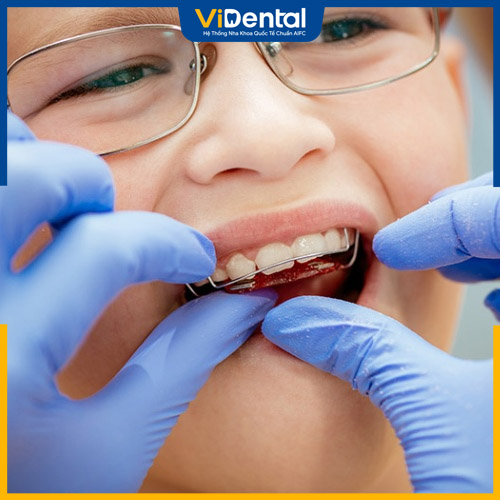 Trẻ nhỏ trong độ tuổi thay răng sữa thích hợp niềng răng tháo lắp