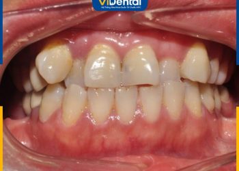 Răng khấp khểnh có bọc sứ được không