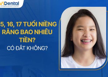 15, 16, 17 Tuổi Niềng Răng Bao Nhiêu Tiền, Có Đắt Không?