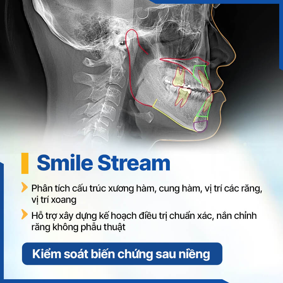 Công nghệ Smilestream tại nha khoa ViDental