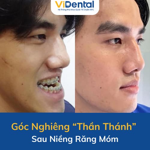 Niềng răng móm tạo cằm Vline, không cần phẫu thuật (2)