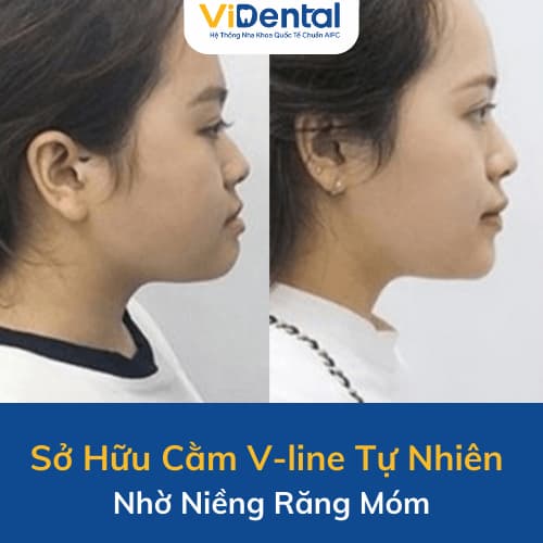 Niềng răng móm tạo cằm Vline, không cần phẫu thuật (3)