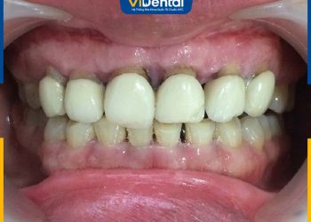 Bọc Răng Sứ Titan Có Bị Đen Không? Nguyên Nhân Và Cách Khắc Phục