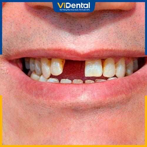 Phương pháp dành cho đối tượng mất 1-3 răng xen kẽ