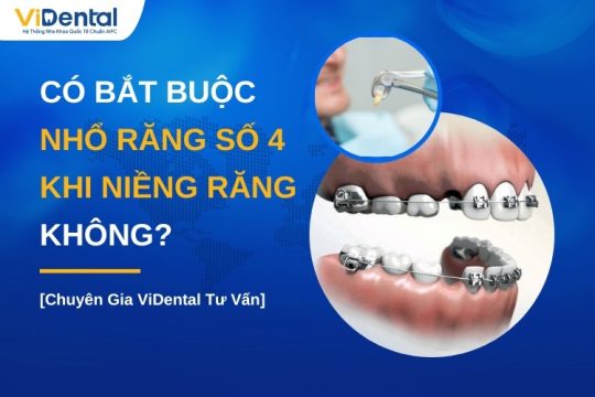 Có bắt buộc nhổ răng số 4 khi niềng răng không