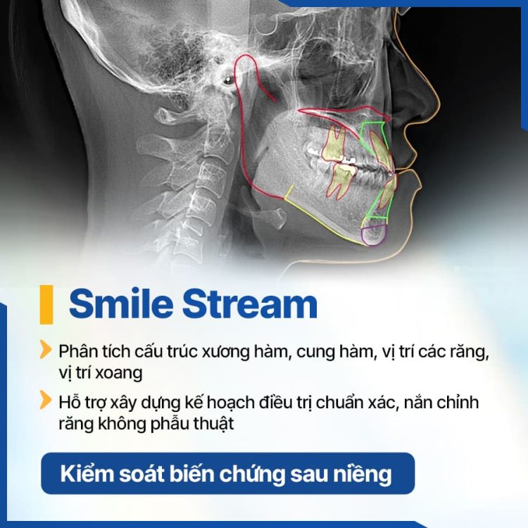 cong-nghe-smile-stream-kiem-soat-bien-chung-sau-nieng