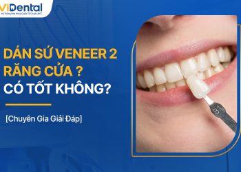 Dán Sứ Veneer 2 Răng Cửa Có Tốt Không? Bảng Giá Chi Tiết Nhất