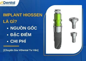 Implant Hiossen có tốt không