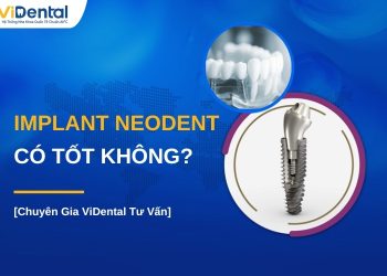 Implant Neodent có tốt không