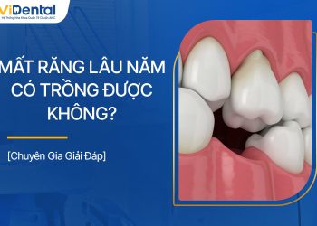 Mất Răng Lâu Năm Có Trồng Được Không? Chuyên Gia Giải Đáp