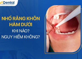 Nhổ Răng Khôn Hàm Dưới Khi Nào, Có Nguy Hiểm Không?